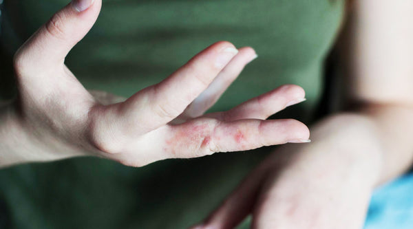 Knowing The Difference Between Eczema and Dermatitis