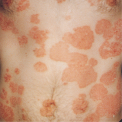 Psoriasis Support
