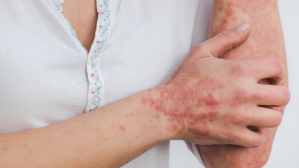 Everything you need to know about Psoriasis