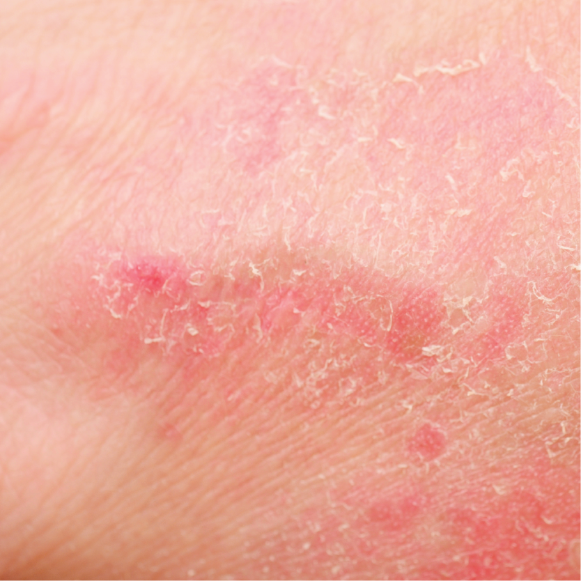 Dermatitis & Eczema Support – Plunkett Pharmaceuticals