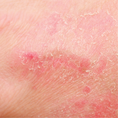 Eczema & Dermatitis